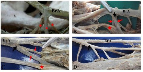 Figure 2 from Surgical anatomy of the profunda brachii artery | Semantic Scholar