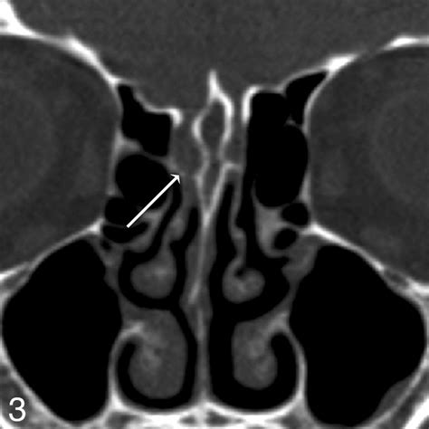 CSF Leaks: Correlation of High-Resolution CT and Multiplanar