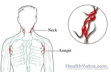 Cat Scratch Fever Definition, Causes, Symptoms, Complications and Cost Surgery Treatment ...