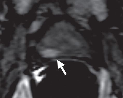 Imaging Guided Prostate Biopsy Conventional And Emerging Techniques Radiographics