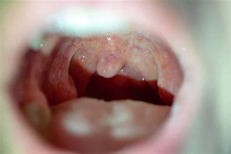 ᐈ Tonsils stock images Royalty Free tonsils photos download on