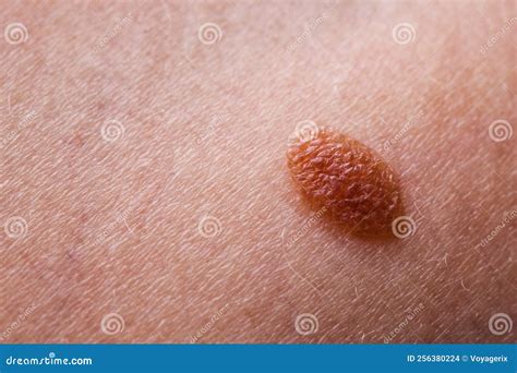 Closeup Brown Mole On Caucasian Woman Skin Stock Photo Image Of