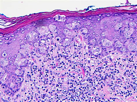 Paget's Disease Of The Nipple And Inflammatory Breast Cancer at Daryl