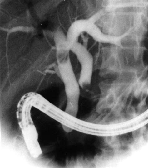 Double Bile Duct With Ectopic Drainage Into Stomach Gastrointestinal