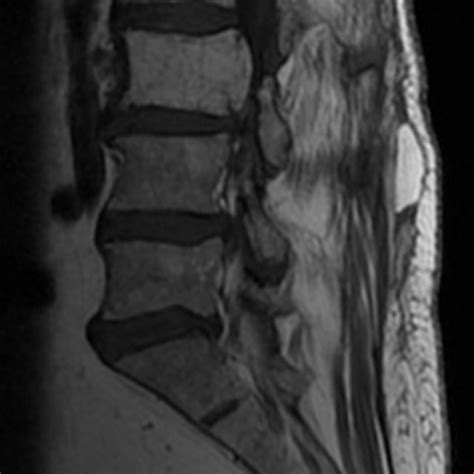 Mri Scan Revealing The Hemangioma That Expands Posteriorly To The