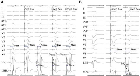 A Beginner S Guide To Permanent Left Bundle Branch Pacing Heart Rhythm