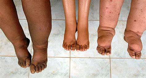 Lymphedema Pictures Symptoms Causes And Treatment