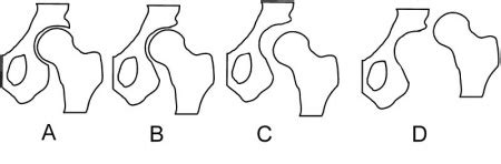 Barlow and Ortolani Tests - Physiopedia