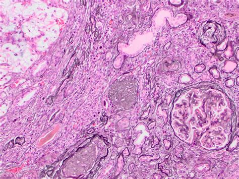 Membranous Nephropathy Histology