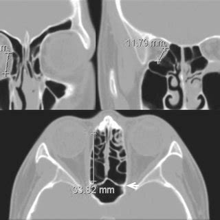 Lamina Papyracea Fracture Update On Orbital Anatomy Eye