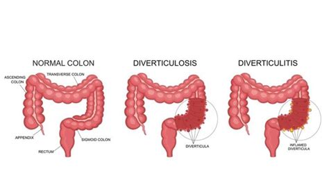 Diverticulitis Causes Symptoms Diagnosis Treatment