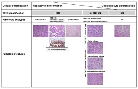 Spectrum Of Primary Liver Cancers According To Cellular Download Scientific Diagram