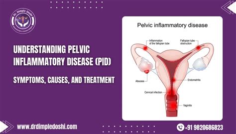 pelvic inflammatory disease pid symptoms  treatment