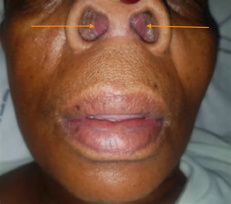 An Unusual Collection Nasal Septal Abscess Secondary To A Furuncle