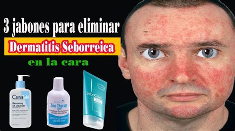 3 Jabones Para Eliminar La Dermatitis Seborreica En La Cara Sin