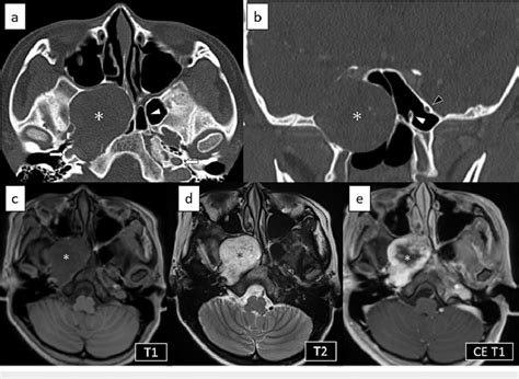 Preoperative Ct And Mri The Tumor Occupied The Floor Of The Sphenoid