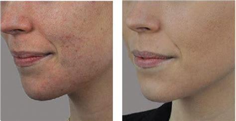 Dpc Laser Acne Treatments Vertex Aesthetics