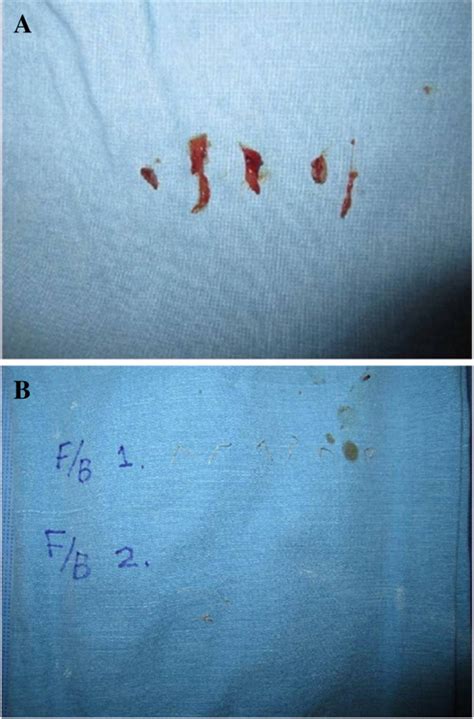 Postoperative Images After Incision And Drainage A Granulation Tissue Download Scientific