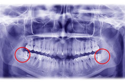 Maxilofacial Muelas Del Juicio Ayuda Y Respuestas