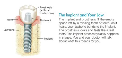 Dental Implant Abutment Crown