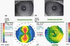 Topograf A Corneal