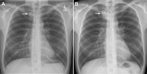 Clinical And Chest Radiographic Features Of Missed Lung Cancer And Their Association With