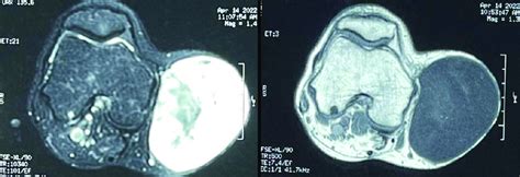 MRI findings (T1-and T2-weighted images). | Download Scientific Diagram