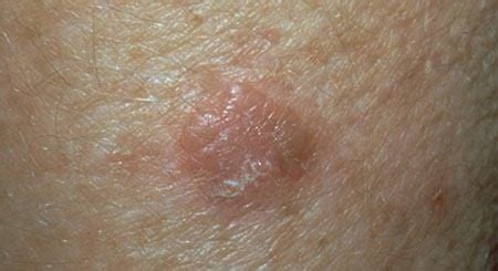 Squamous Cell Carcinoma South Nassau Dermatology