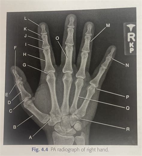 PA Radiograph Of Right Hand Labeling Diagram Quizlet