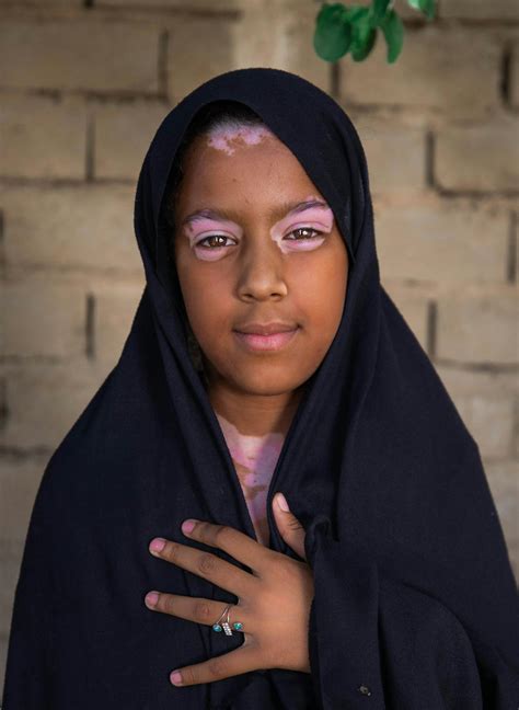 Child with Vitiligo · Free Stock Photo