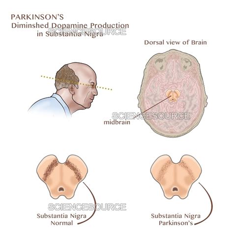 Substantia Nigra Parkinson S Disease Stock Image Science Source