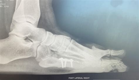 Joint fusion with bone grafts : r/surgery