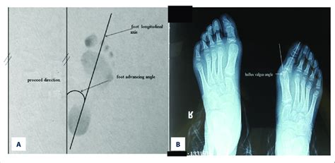 Schematic diagram of foot progression angle (A) and hallux valgus angle... | Download Scientific ...