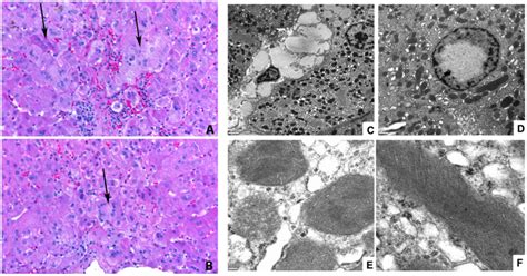 Histological And Ultrastructural Analysis Of Liver Tissue From Patient