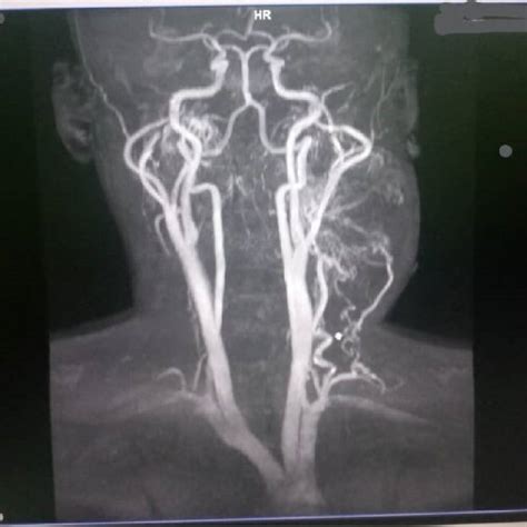 Carotid Angiography Shows The Tumor Encasing The Carotid On The Left Ct