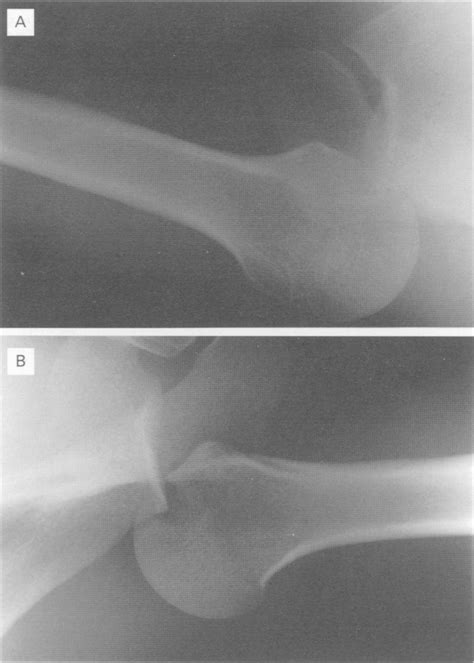 Axial View Radiographs Of Right And Left Shoulders Download