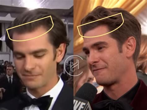 Andrew Garfield Hair Transplant Hair Loss And Technical Analysis