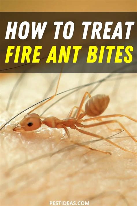 Treat Fire Ant Bites- No More Itch