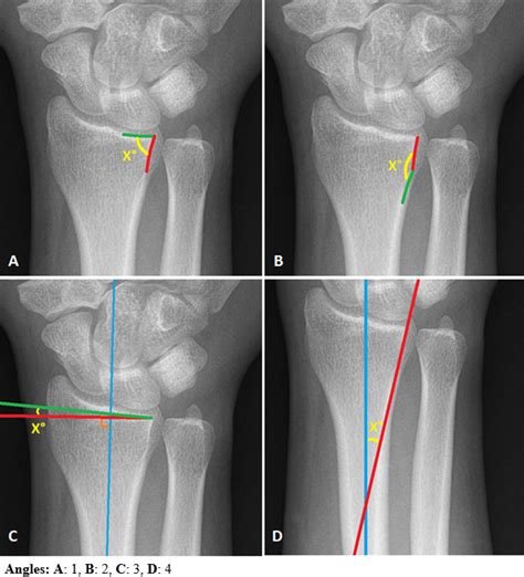 Aahs Quantitative Analysis Of The Volar Ulnar Corner Of The Distal