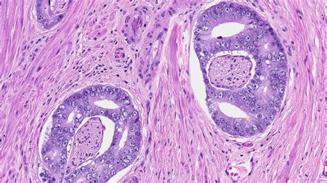 Adenocarcinoma of the prostate gland | Ottawa Atlas of Pathology