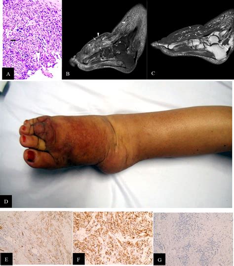 Frontiers Magnetic Resonance Findings Of Stewarttreves Syndrome In