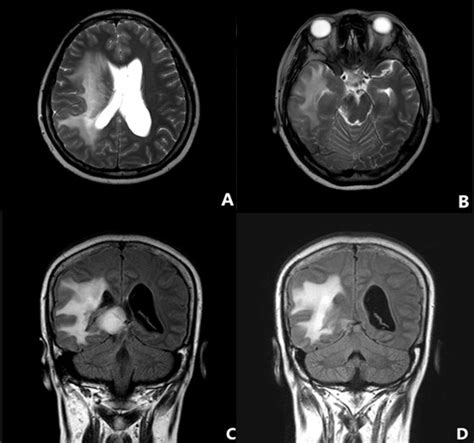 brain radiation therapy side effects