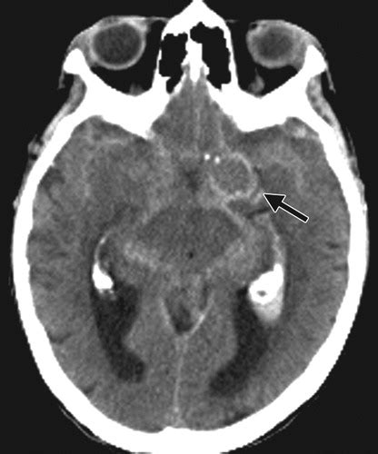 Cerebral Aneurysm Ct