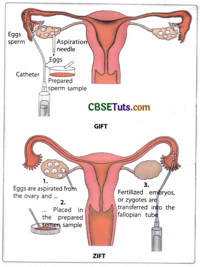 Assisted Reproductive Technology Art Techniques Gamete