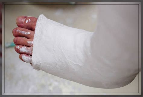 Plaster of Paris Bandage: When Do You Need It? - Engiomed