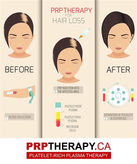 prp hair before and after – prp injection cost ontario – microneedling ...