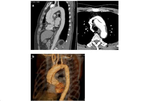 Aortic Dissection Ct Scan