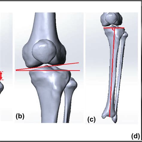 Data Measurement A Fibular Head Height Is The Distance Between The