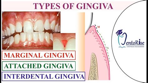 Gingiva Anatomy Gingiva Types Carranza Marginal Attached