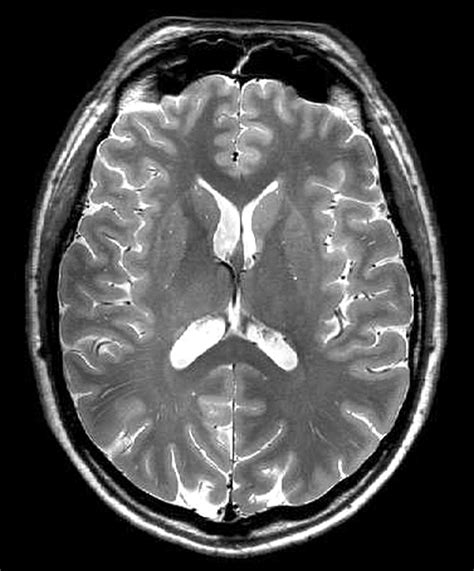 A Review Of Structural Magnetic Resonance Neuroimaging Journal Of